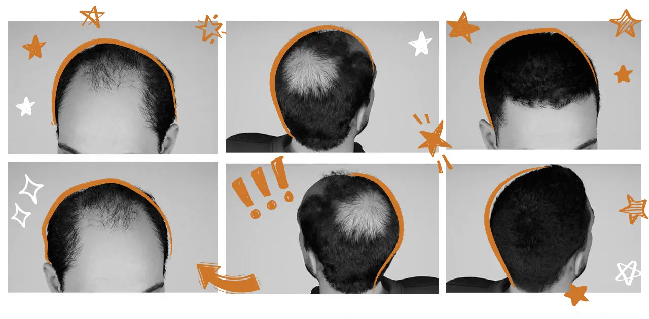 Best-Hair-Loss-Treatment-for-Men